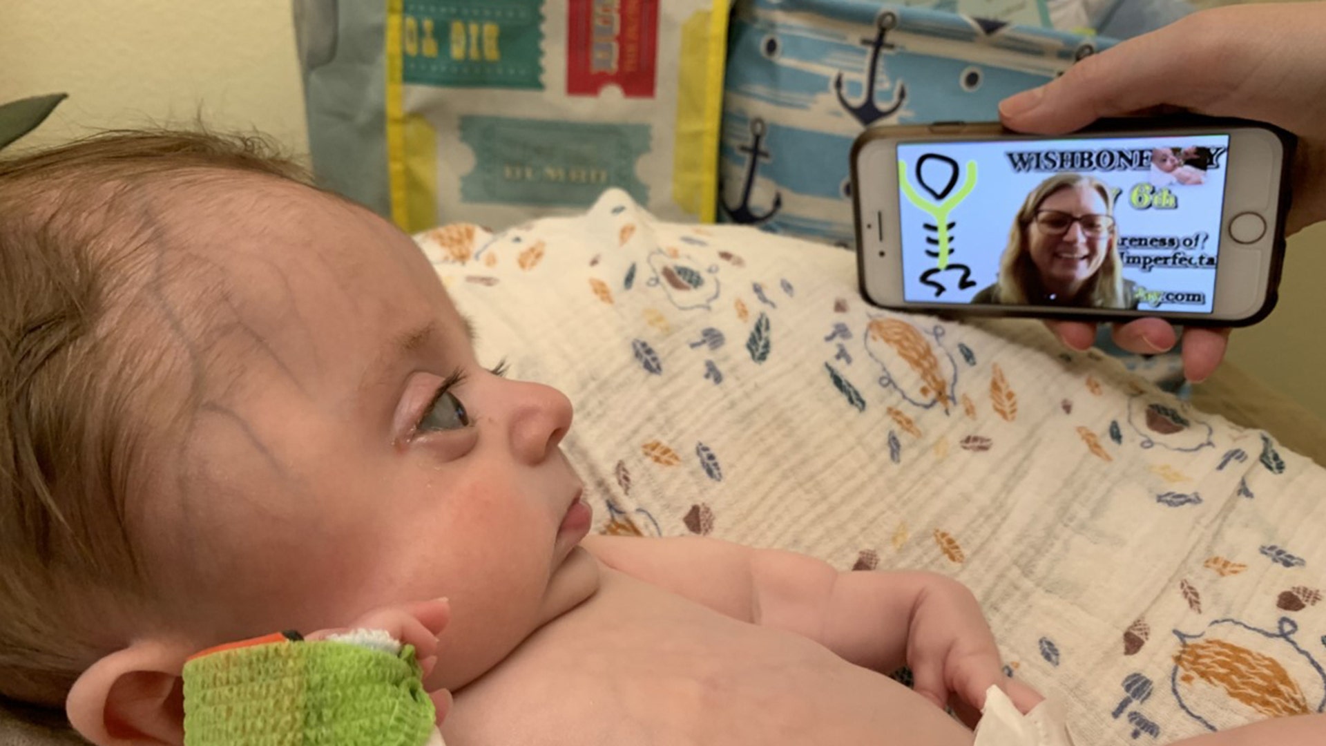 WISHBONE DAY today! Baby Luke needed cast for fracture on right arm. SEE IMAGES! Luke is an OI baby "Brittle Bone Disease" UCLA Therapist: Liz instructed baby Luke's parents to apply cast. Parents: Drew &amp; Carrie Young. *California Residents/LA County Baby: Luke Young