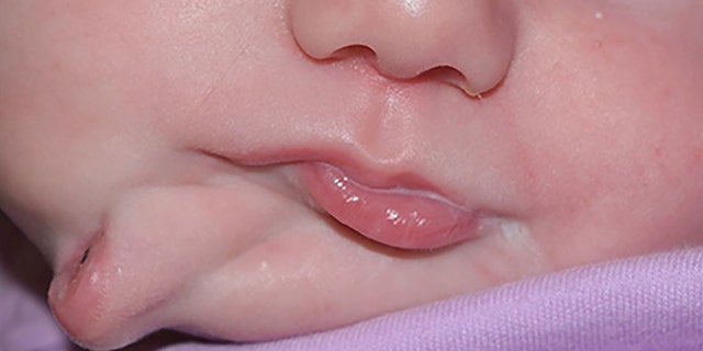 A baby was recently born with two mouths, doctors say. (Photo courtesy of BMJ Journals)
