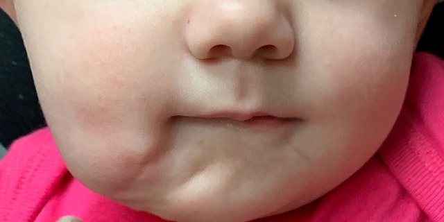 The infant developed some swelling after doctors surgically removed the accessory mouth. (Photo courtesy of BMJ Journals)