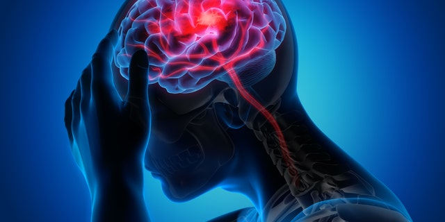 Ilustração médica do cérebro com sintomas de acidente vascular cerebral.  Pesquisadores descobriram que o risco de acidente vascular cerebral isquêmico é maior entre pacientes hospitalizados com COVID-19 em comparação com pacientes internados com gripe. 