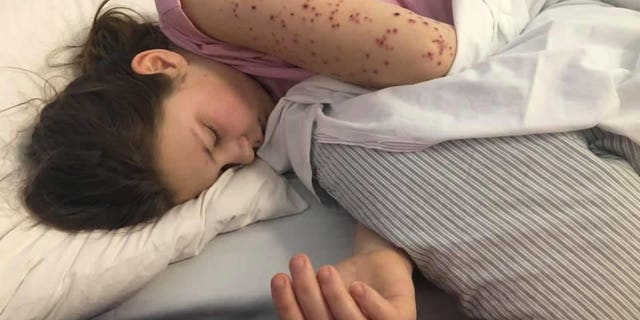 Mom blames coronavirus after teen develops body rash, inflamed organs 1