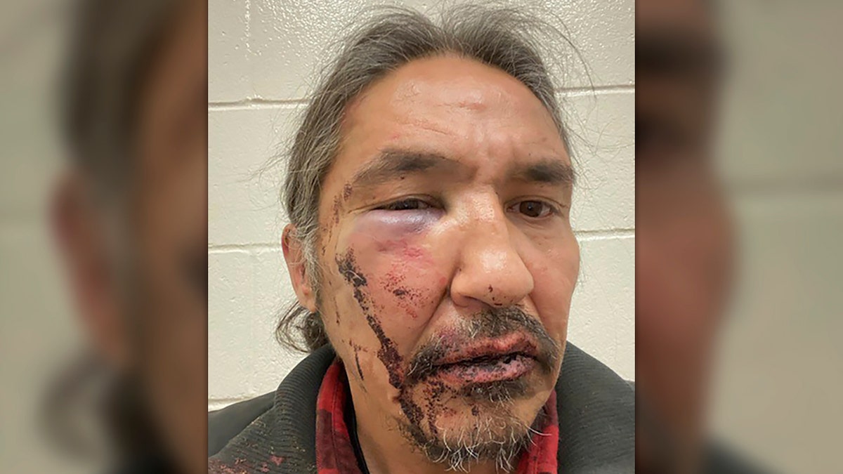 This March 10, 2020 photo shows the bloodied face of Athabasca Chipewyan First Nation Chief Allan Adam after a confrontation with Royal Canadian Mounted Police. Canadian Prime Minister Justin Trudeau says police dashcam video of the violent arrest of the Canadian aboriginal chief is shocking and not an isolated incident. (Allan Adam/The Canadian Press via AP)