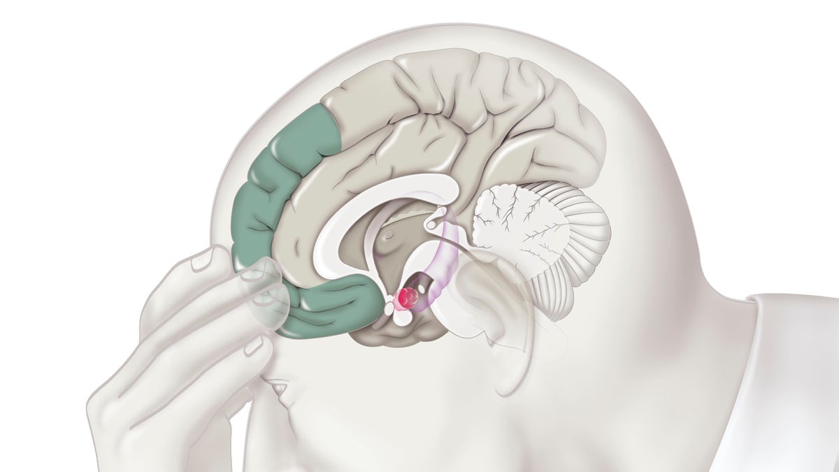 A new study estimates how much so-called "deaths of despair" could increase amid the COVID-19 pandemic. The above illustration shows areas of the brain involved in the process of depression.?