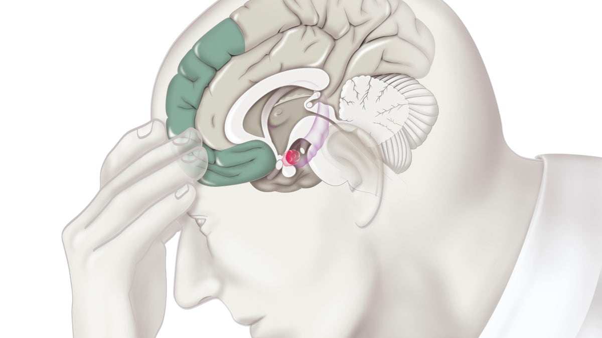 A new study estimates how much so-called "deaths of despair" could increase amid the COVID-19 pandemic. The above illustration shows areas of the brain involved in the process of depression.