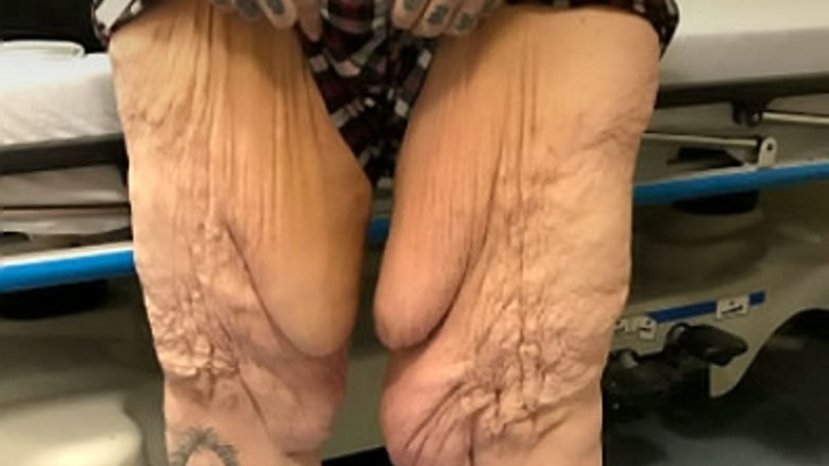 Loose skin on legs after weight loss sale