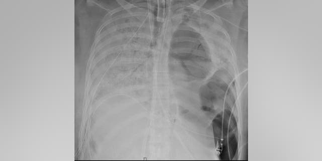 An x-ray of the patient's lungs before the transplant.