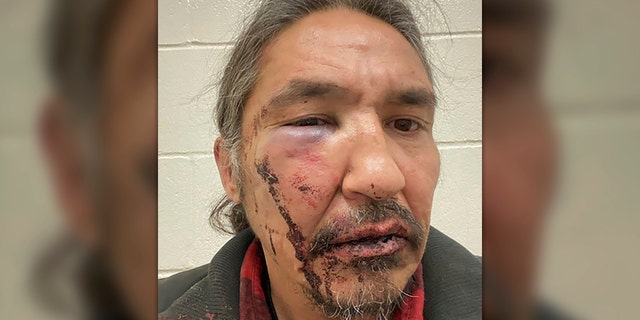 This March 10, 2020 photo shows the bloodied face of Athabasca Chipewyan First Nation Chief Allan Adam after a confrontation with Royal Canadian Mounted Police. Canadian Prime Minister Justin Trudeau says police dashcam video of the violent arrest of the Canadian aboriginal chief is shocking and not an isolated incident. (Allan Adam/The Canadian Press via AP)