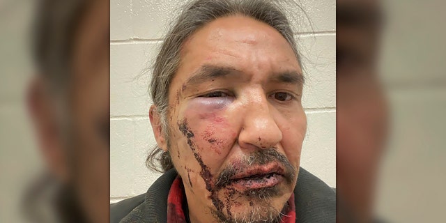 This March 10, 2020 photo shows the bloodied face of Athabasca Chipewyan First Nation Chief Allan Adam after a confrontation with Royal Canadian Mounted Police. Canadian Prime Minister Justin Trudeau says police dashcam video of the violent arrest of the Canadian aboriginal chief is shocking and not an isolated incident. (Allan Adam/The Canadian Press via AP)