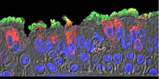 SARS-CoV-2 (red) infected ciliated cells in the COVID-19 patient's bronchi. (Takanori Asakura, PhD, UNC School of Medicine)