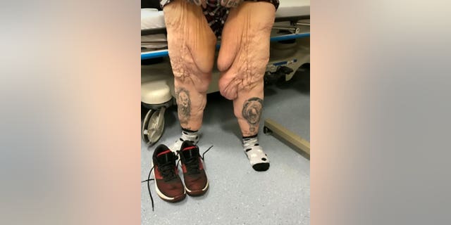 Jen Costa's legs before the operation. (SWNS)