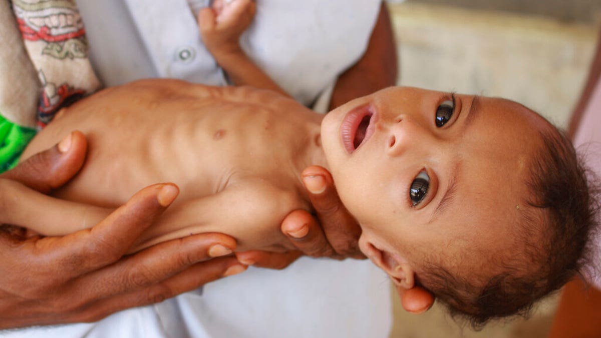 Seven-month-old Issa Ibrahim Nasser brought to a clinic in Deir Al-Hassi, Yemen, in June.