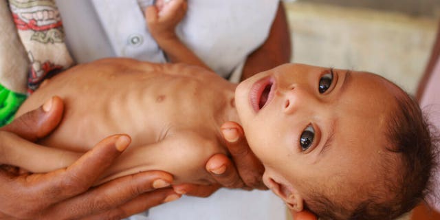 Seven-month-old Issa Ibrahim Nasser brought to a clinic in Deir Al-Hassi, Yemen, in June.