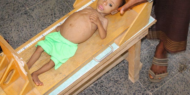 Hundreds of children have suffered from acute severe malnutrition because of poverty and grinding conflict in Yemen.