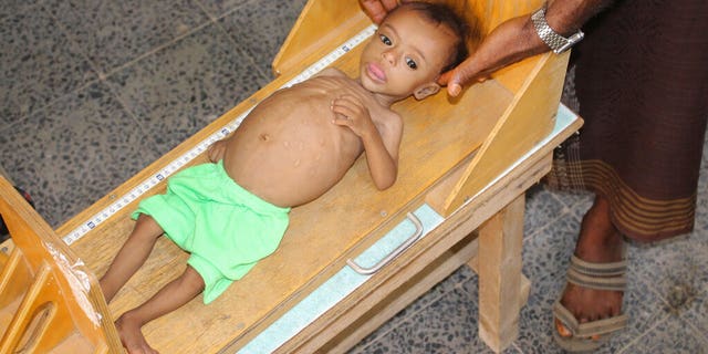 Hundreds of children have suffered from acute severe malnutrition because of poverty and grinding conflict in Yemen.