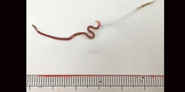 The worm tweezed out of the woman's tonsil was 38 millimeters (1.5 inches) long. (Photo credit: American Society of Tropical Medicine and Hygiene)