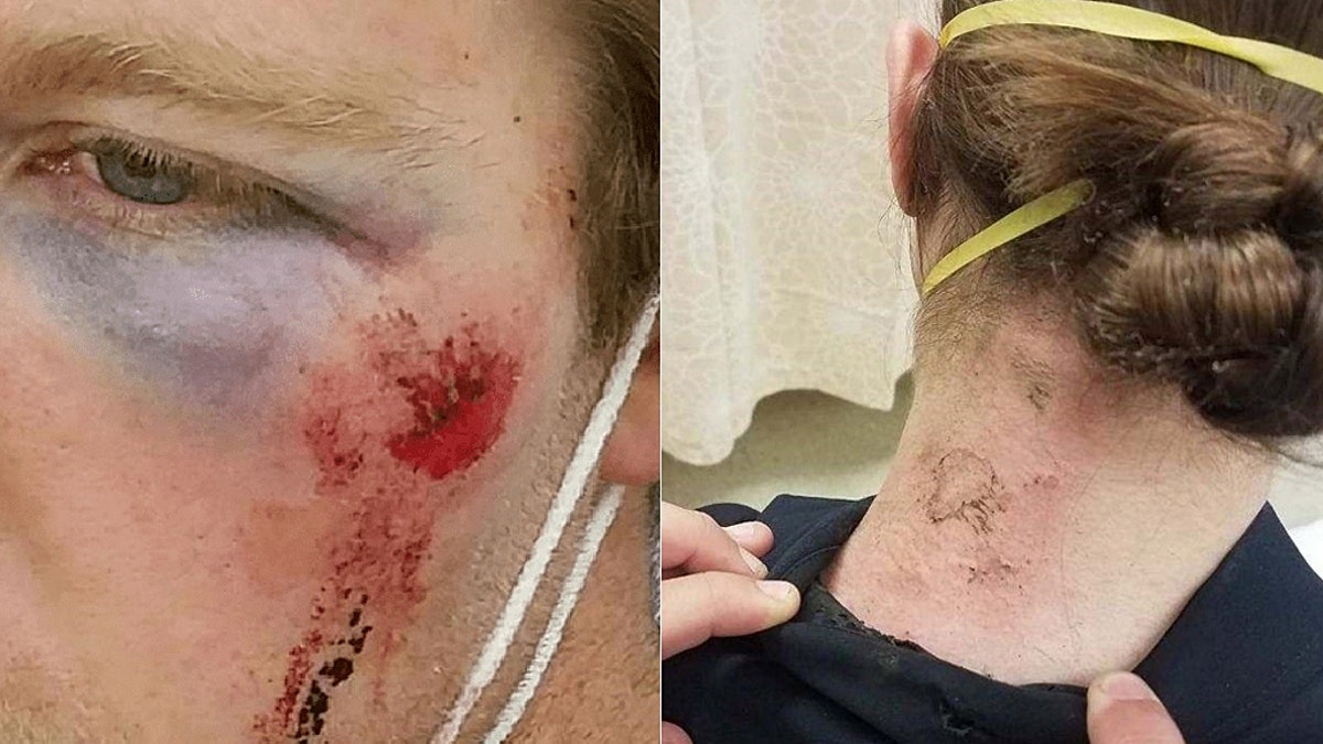 An officer's injuries after an explosive was thrown at them. Left photo shows injury to eye; right image shows burn injuries to back of neck. (Seattle Police Department)