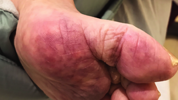 Evidence of coronavirus-related skin lesions, discoloration, rash supported by new study, researchers say