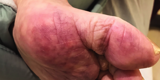 Livedo racemosa, or persistent skin discoloration, on a patient's left foot and toes. (Photo credit JAMA Dermotology)