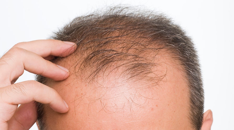 Details more than 143 hair loss symptoms