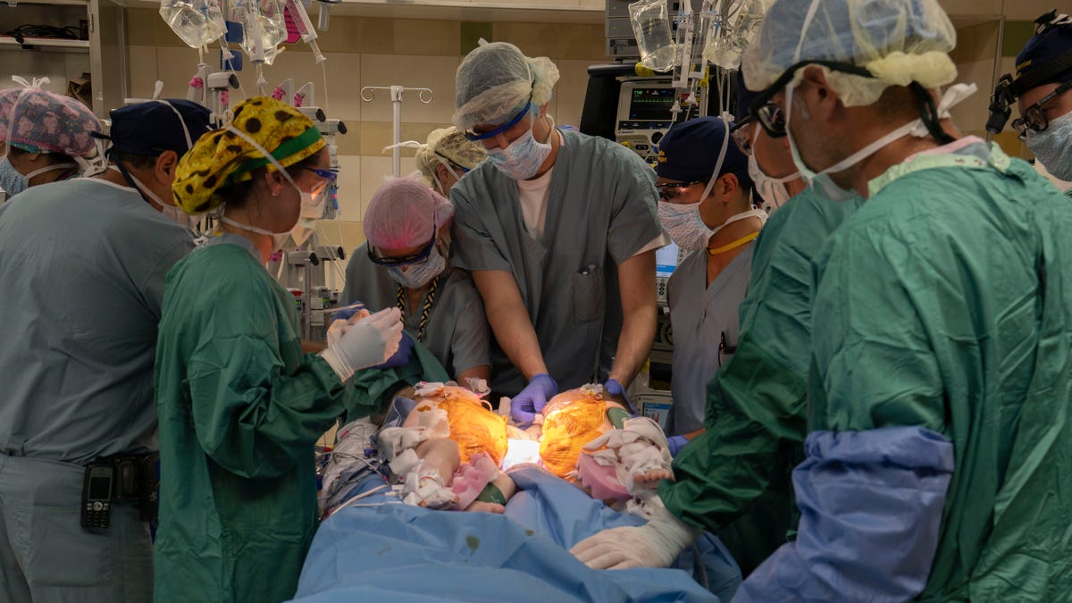 The teams color-coded their surgical caps to help determine who was working on each twin.