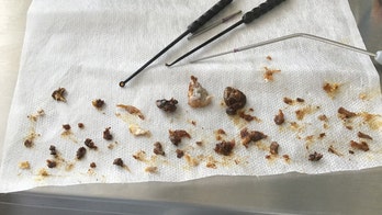 Clumps of man's earwax removed after 16 years of buildup