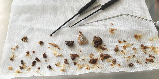 Sixteen years worth of wax on display from a patient who hadn't cleaned his ears in over a decade and a half. (Neel Raithatha / The Hear Clinic &amp; Clearwax /CATERS NEWS)