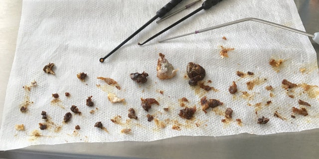 Sixteen years worth of wax on display from a patient who hadn't cleaned his ears in over a decade and a half. (Neel Raithatha / The Hear Clinic & Clearwax /CATERS NEWS)