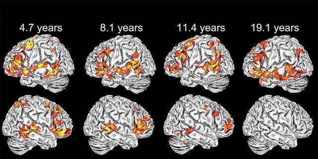 Activation maps of various ages. As seen in the bottom row, right-hemisphere language activation gradually declines over time. (Photo courtesy of Elissa Newport)