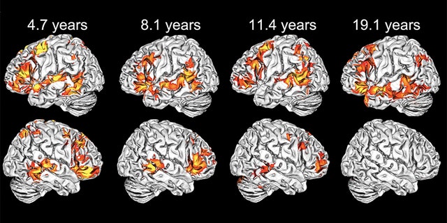 Activation maps of various ages. As seen in the bottom row, right-hemisphere language activation gradually declines over time. (Photo courtesy of Elissa Newport)