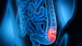 Start screenings for colorectal cancer at age 45, panel advises
