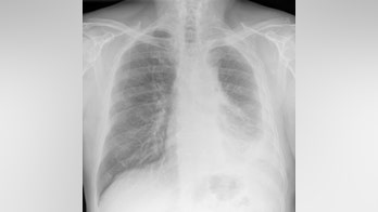 Drug combo to treat mesothelioma approved by FDA