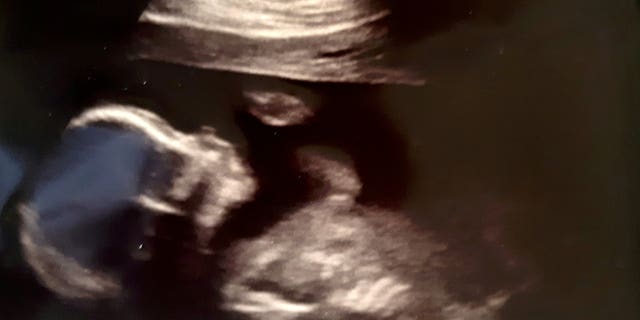 “It was a huge shock – I had no idea I was having a boy. At two scans I'd been told my baby was a girl.”