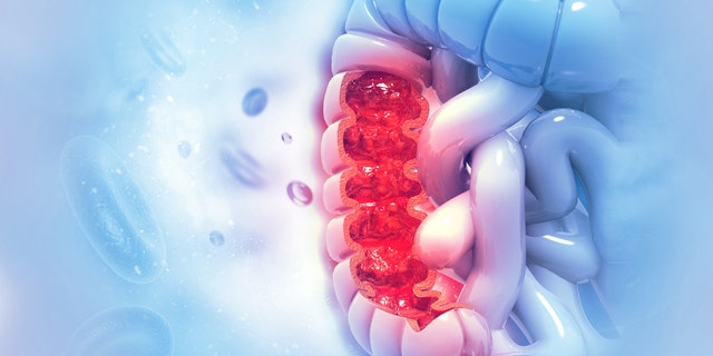 El martes, un panel de expertos nacionales recomendó exámenes de detección de cáncer de colon más rápidos, a partir de los 45 años. (IStock)