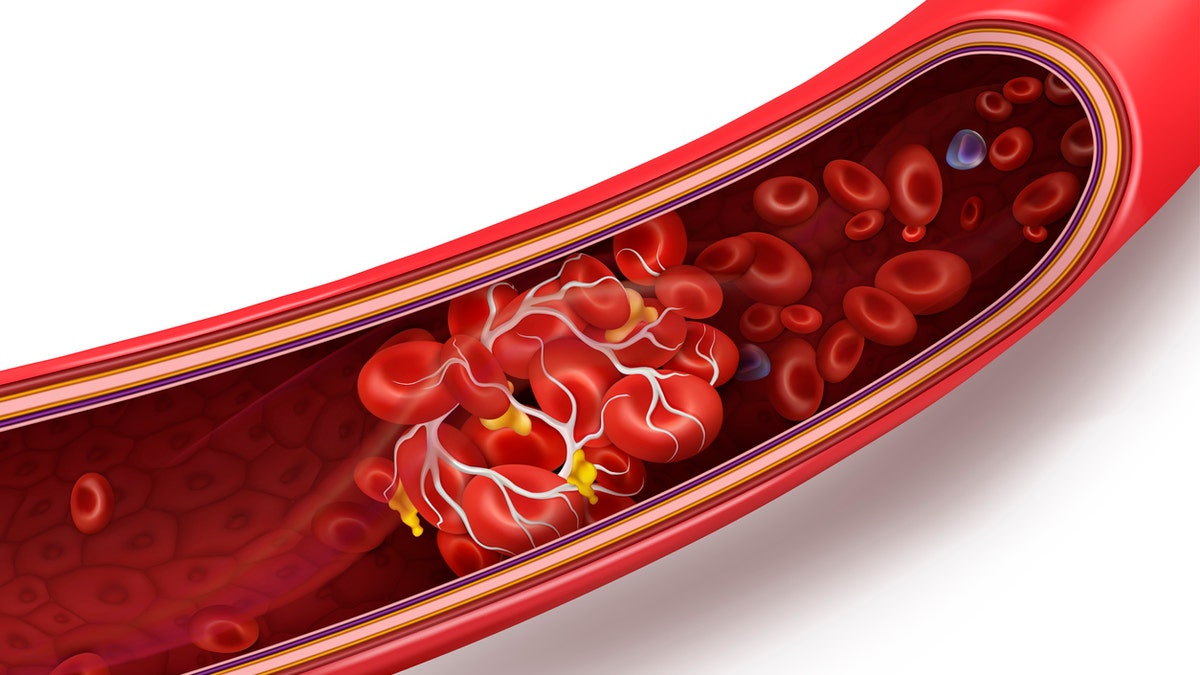 Blood clot (Credit: iStock)