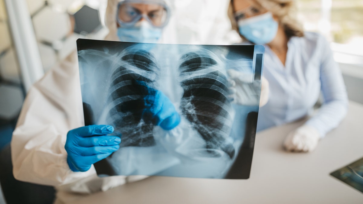 doctors examine x-ray of rib cage