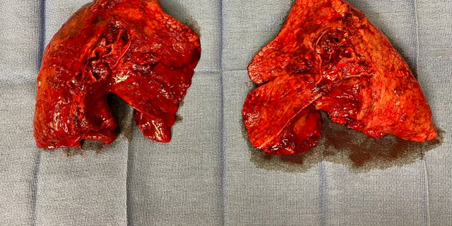 Pictured are Wegg's lungs removed after the transplant. One surgeon said coronavirus patients' lungs "stiffen and harden." (Photo courtesy of Northwestern Memorial Hospital)