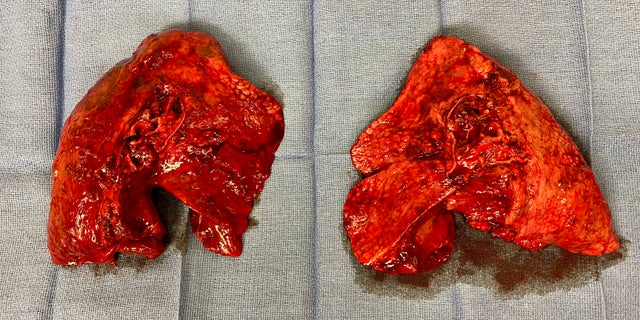 Pictured are Wegg's lungs removed after the transplant. One surgeon said coronavirus patients' lungs "stiffen and harden." (Photo courtesy of Northwestern Memorial Hospital)