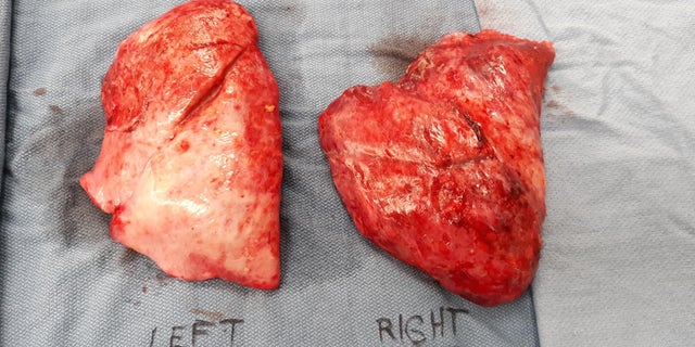 Sanchez's scarred lungs.