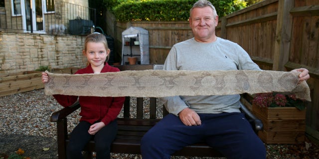 A 7-year-old girl found that her skin was peeling off due to a larger chest spasm when she was walking with her grandfather.