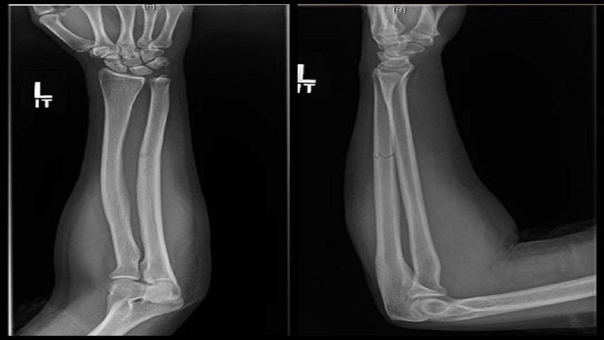 Victims of domestic violence frequently blame the fracture on falls, though falls usually result in a different kind of fracture, a researcher said.