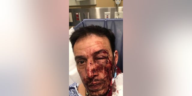 Emerson Antonio Aroche Paz was struck in the head twice around 10 p.m. Nov. 25, he <a href="https://www.bostonglobe.com/2020/12/01/metro/waltham-authorities-offer-5000-reward-information-person-or-persons-responsible-spate-random-attacks/">told The Boston Globe.</a> (Facebook)