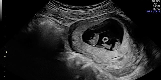 Whittaker said he was stunned to see at least two babies on the ultrasound that fateful September day.