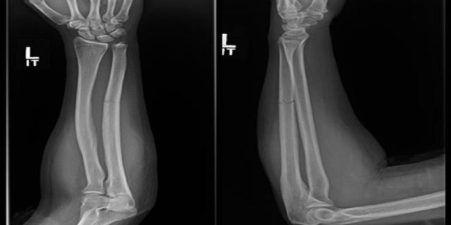 Victims of domestic violence frequently blame the fracture on falls, though falls usually result in a different kind of fracture, a researcher said.