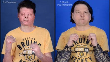 New Jersey man’s double-hand, face transplant is world’s first successful attempt