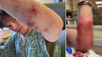 Florida man saves arm after sneaky shark attack: 'Lucky that this wasn't worse'