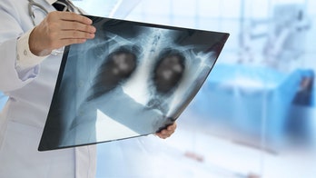 Health panel expands lung cancer screening for more smokers