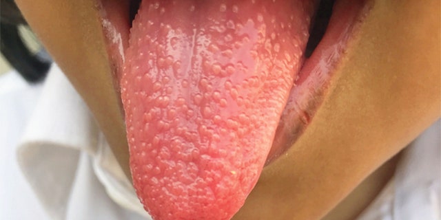 Girl Develops Strawberry Tongue During Bout With Strep Throat Scoopsky