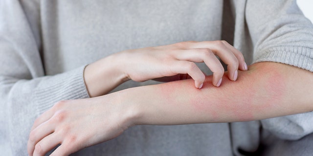 Some Moderna Covid 19 Vaccine Recipients Have Experienced Delayed Skin