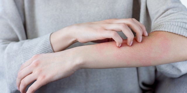 Some Moderna Covid 19 Vaccine Recipients Have Experienced Delayed Skin