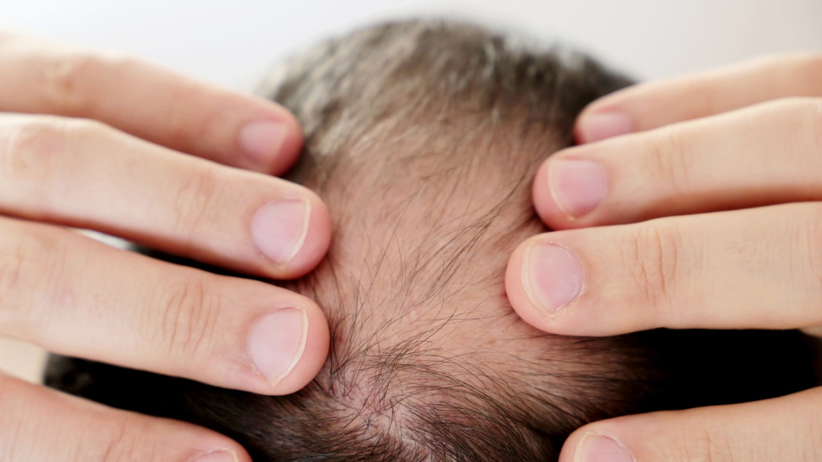 It’s well known that chronic stress can lead to hair loss, but how exactly stress causes hair loss has been a mystery — until now. A new study conducted by researchers at Harvard University may provide a clue. (iStock)